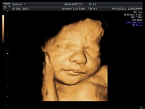 3D-Ultraschallbild eines Kindes