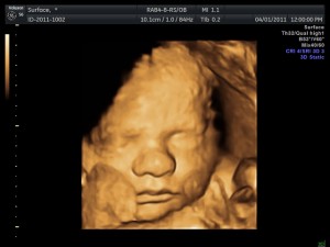 3D-Ultraschallbild eines Kindes